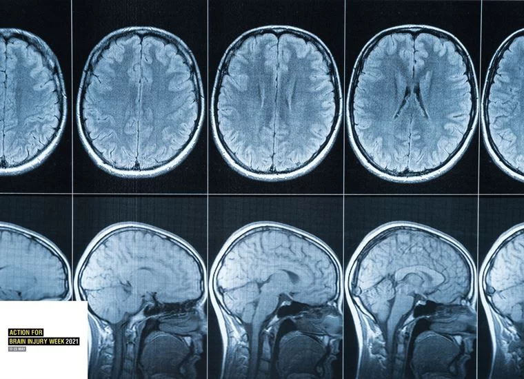 Brain-x-ray-resized-min